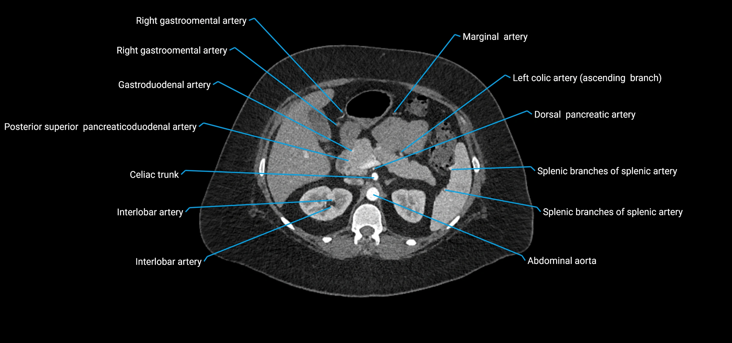 CTA abdomen axial cross sectional anatomy labelled image_58 (2).webp